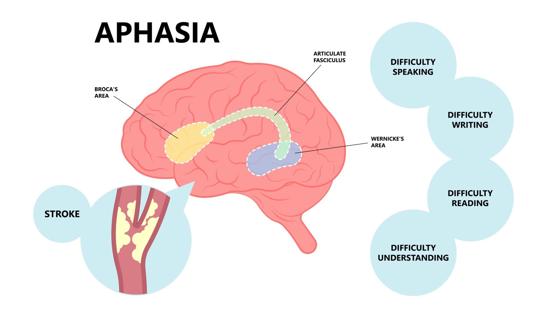 Aphasia A diagram illustrating where in the brain aphasia can occur, labelled areas of broca's area, wernickes area, and articulate fasciculus