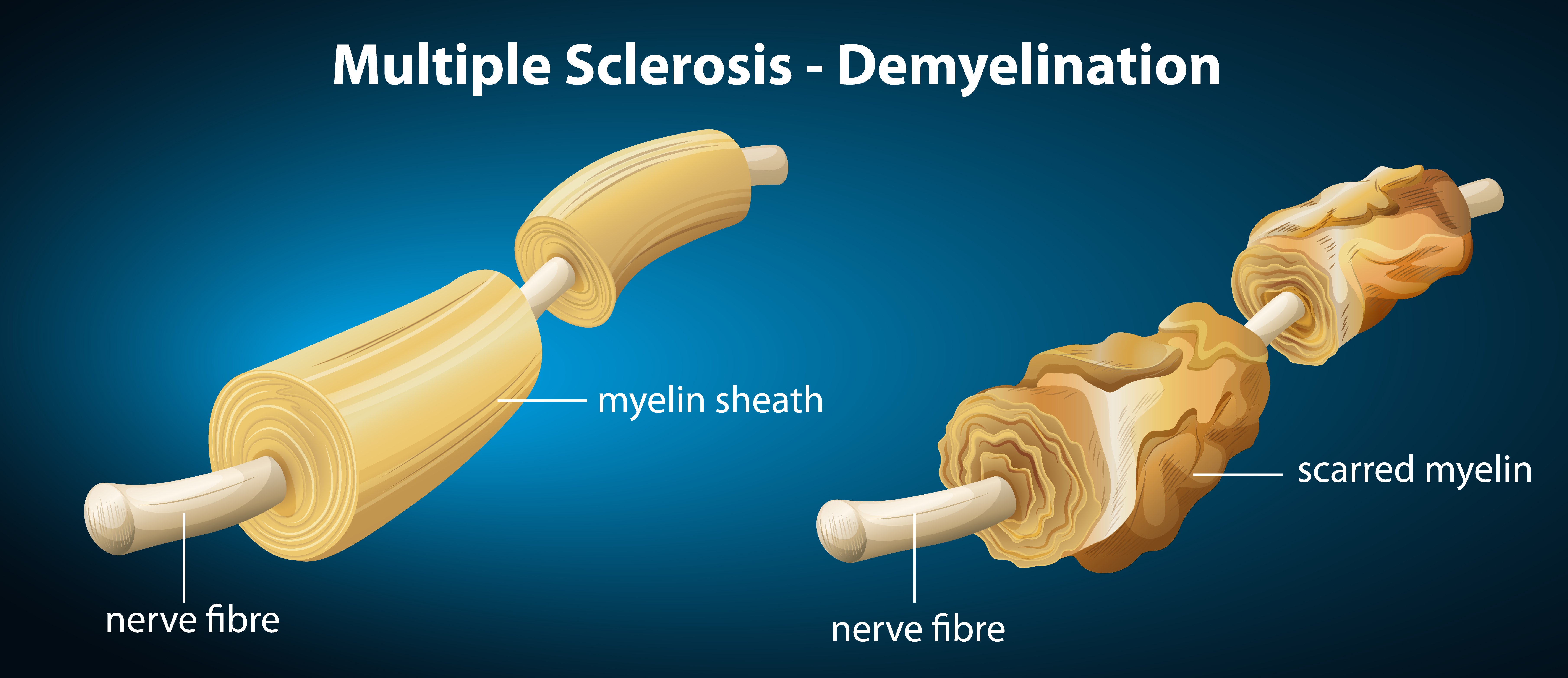 Myelin Sheath 7 demyelination