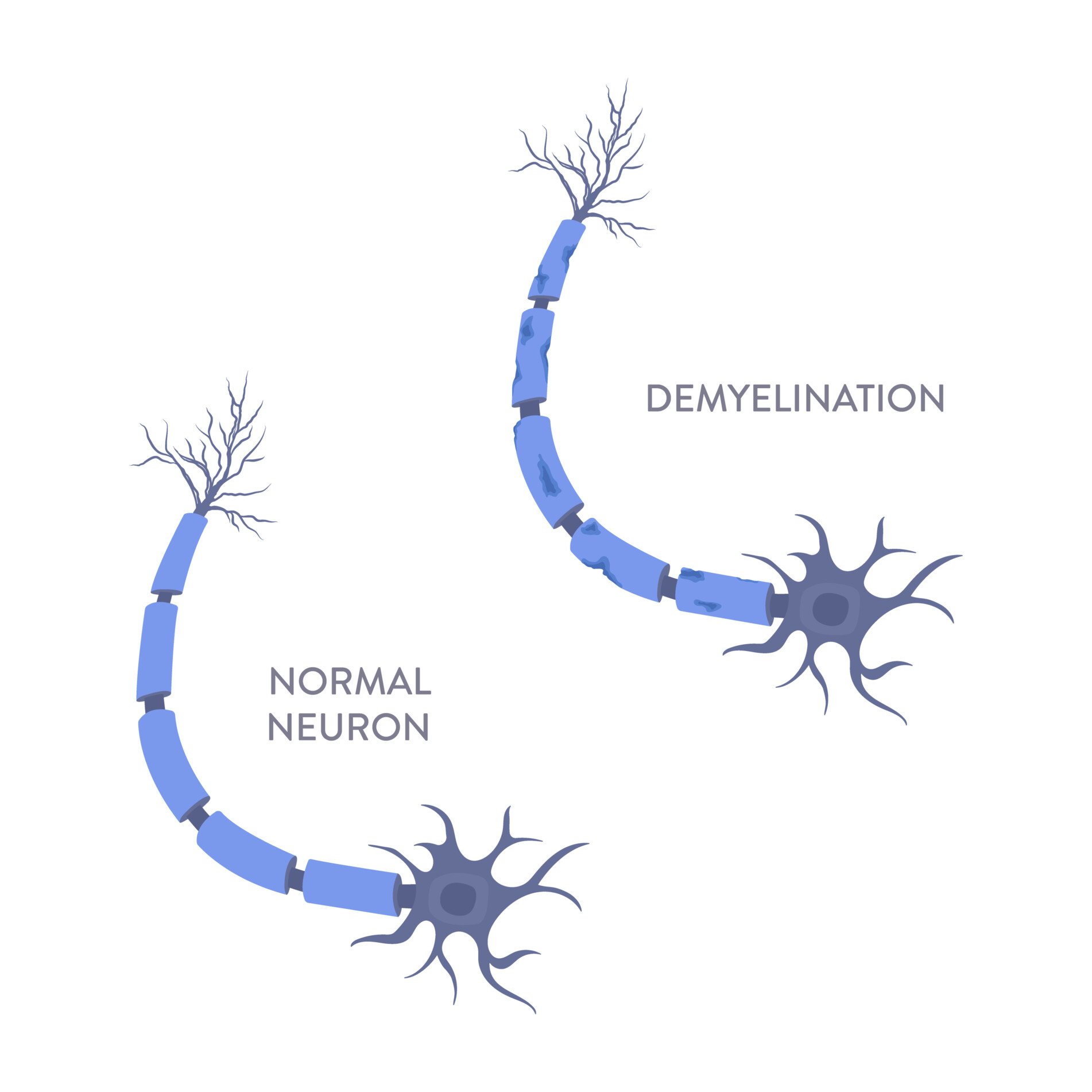 demyelination