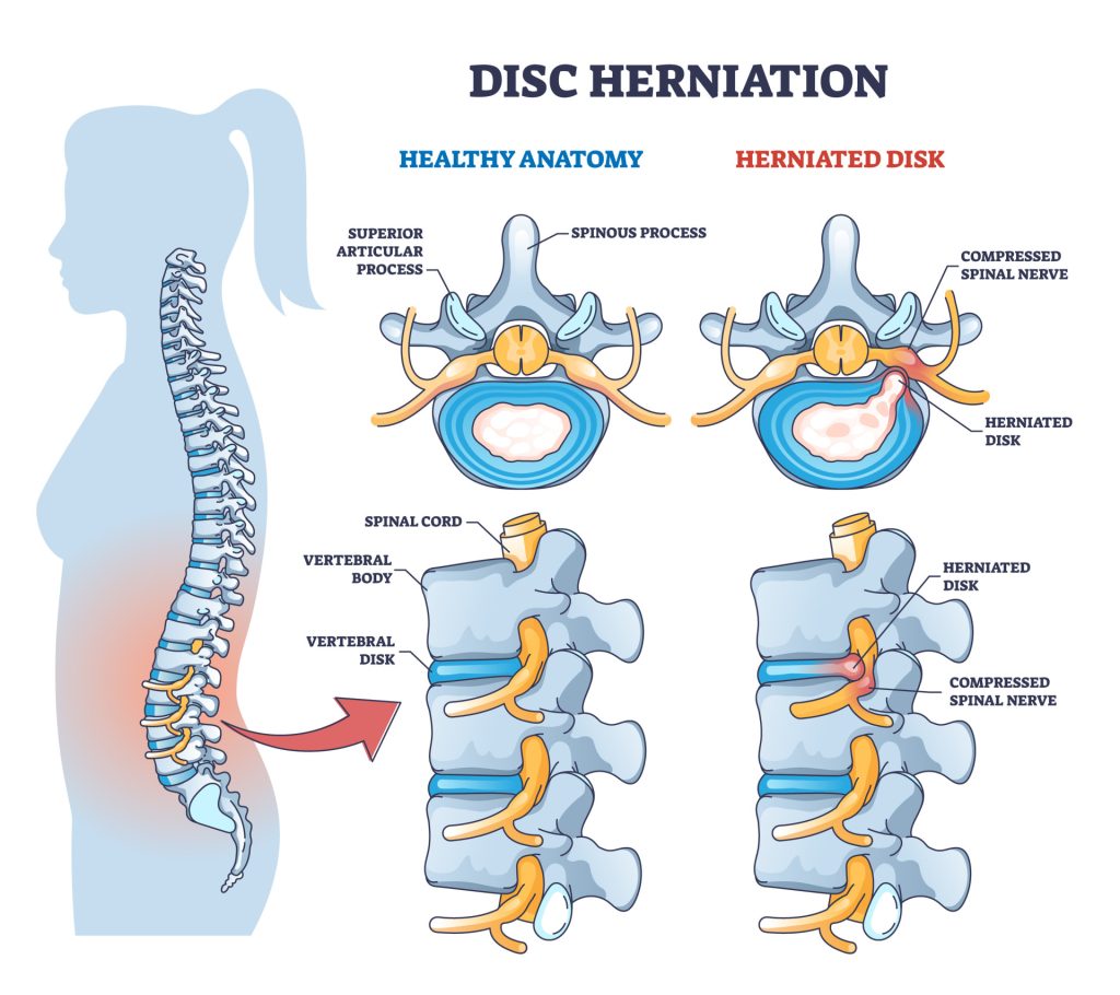 Spinal Nerves: Anatomy, Function, Diagram, Number, & Facts 7 Herniated disc