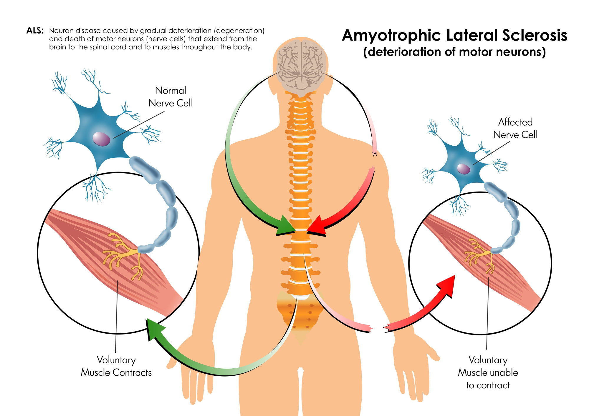 Motor Neuron: Function, Types, And Structure 2 motor neuron disease