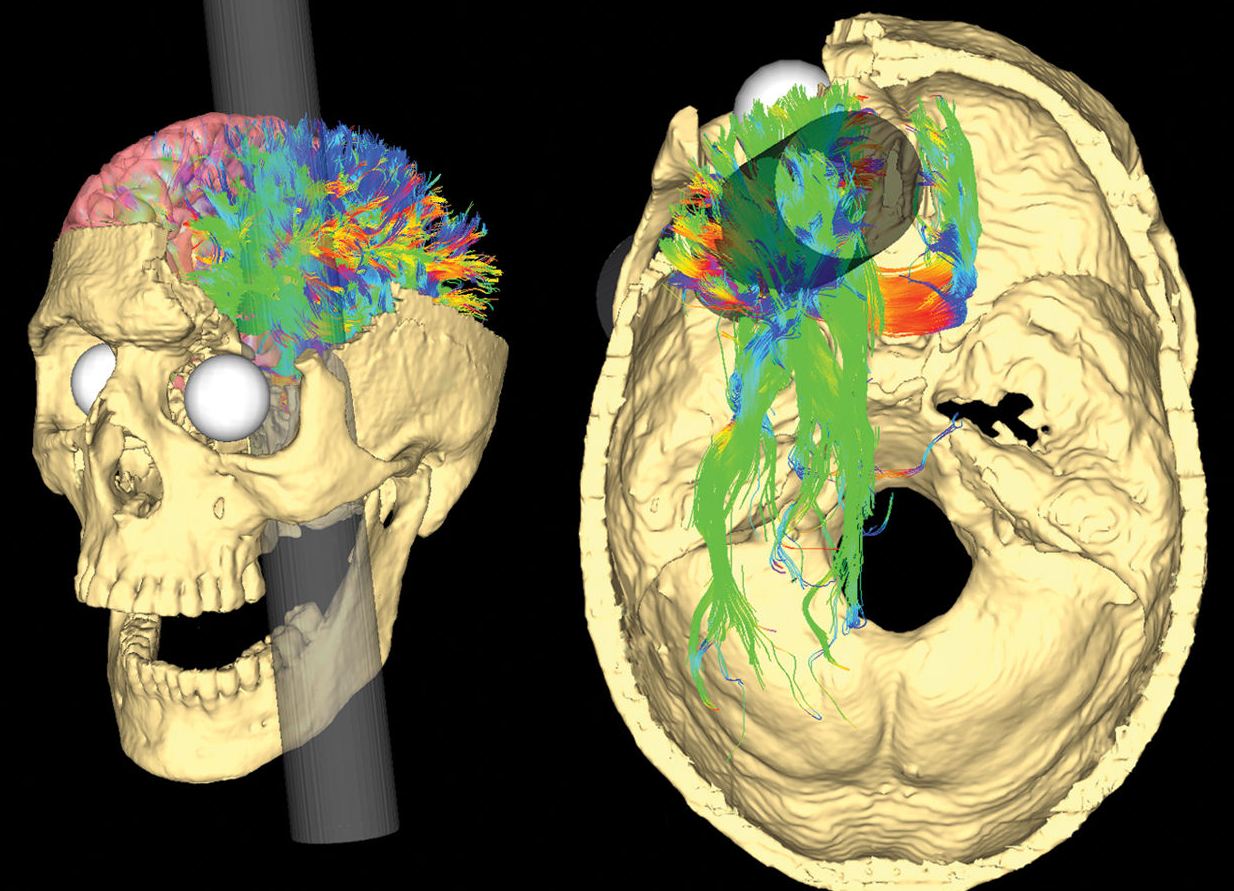 Phineas Gage MRI