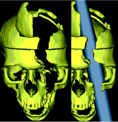 Phineas Gage: His Accident and Impact on Psychology 2 Phineas Gage brain image from Ratiu et al., (2004)